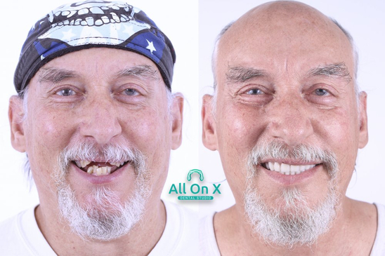 Slider image (8) All on X Dental Studio: Leading Dental Clinic in Los Algodones